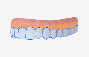 치아 표면 미백제 도포
